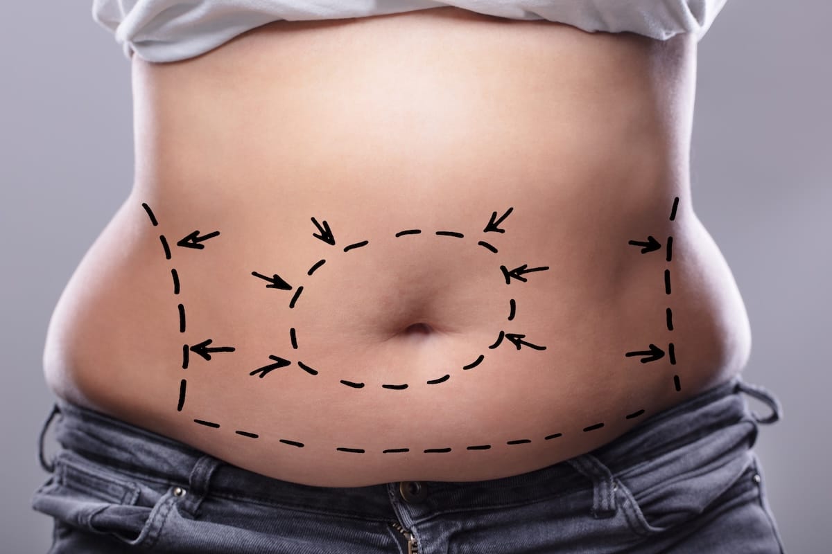 Abdomenoplastia, operația care te scapă de excesul de piele, cicatrici și grăsimea de pe burtă, dar îți întărește și mușchii abdominali 